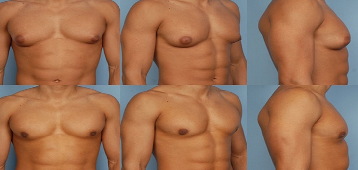 الاضرار النفسية لتثدي الرجال