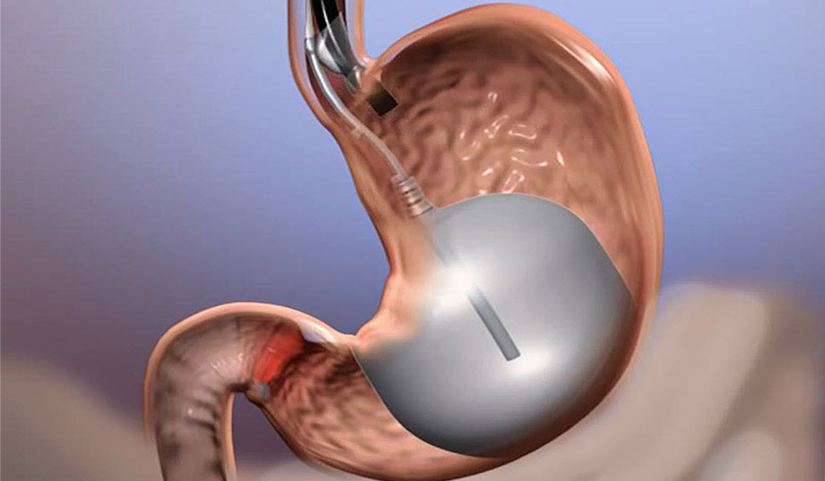 عملية بالون المعدة